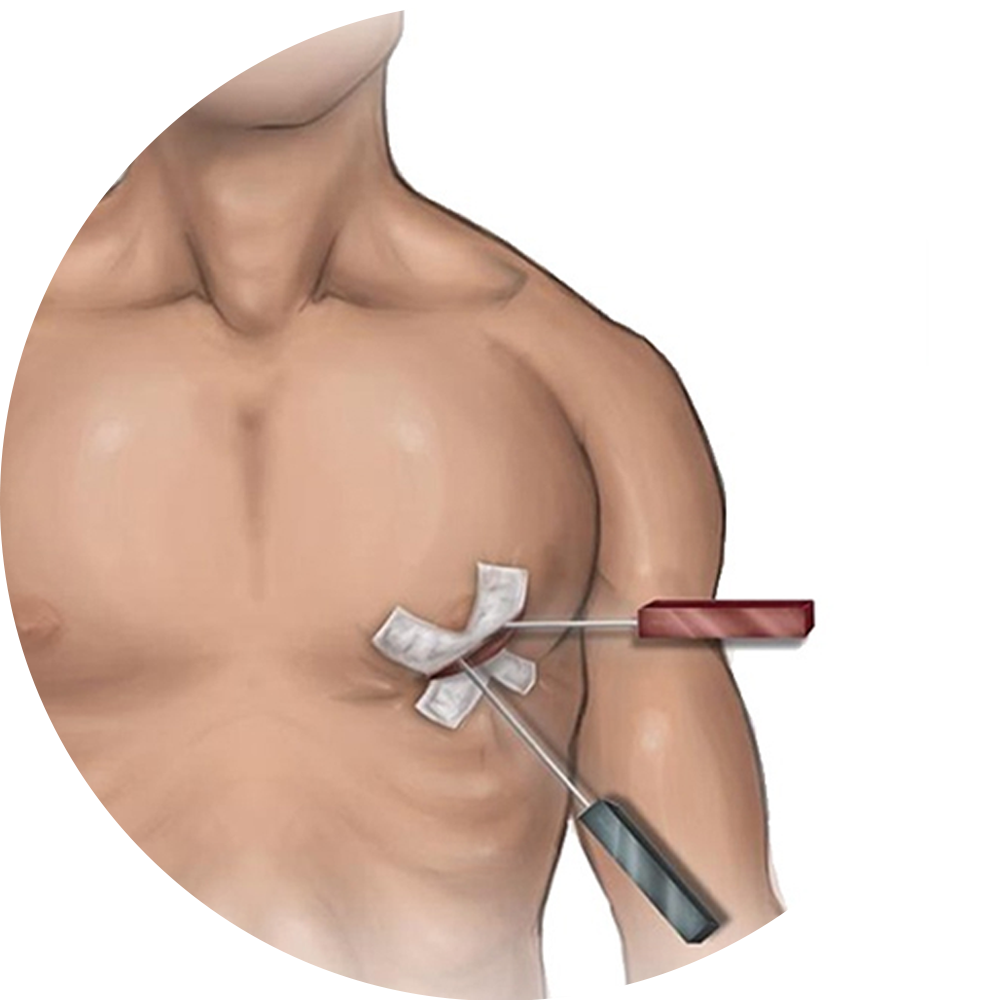 Minimally Invasive CABG